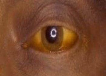 Fièvre Jaune à Tambacounda: Deux individus ont perdu la vie.