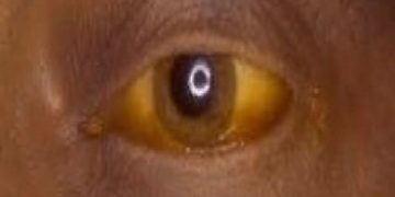 Fièvre Jaune à Tambacounda: Deux individus ont perdu la vie.