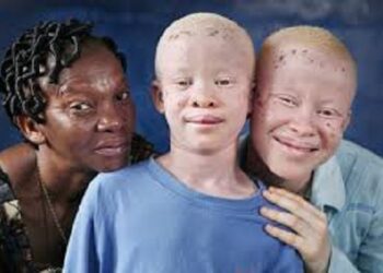 Les albinos demandent à l&rsquo;Etat de régler les problèmes liés à leur handicap