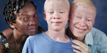 Les albinos demandent à l&rsquo;Etat de régler les problèmes liés à leur handicap