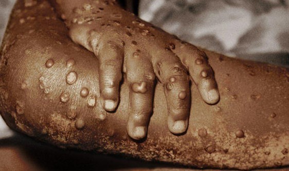 L’OMS annonce 1400 cas de la variole du Singe dans 7 pays d’Afrique parmi lesquels le Cameroun